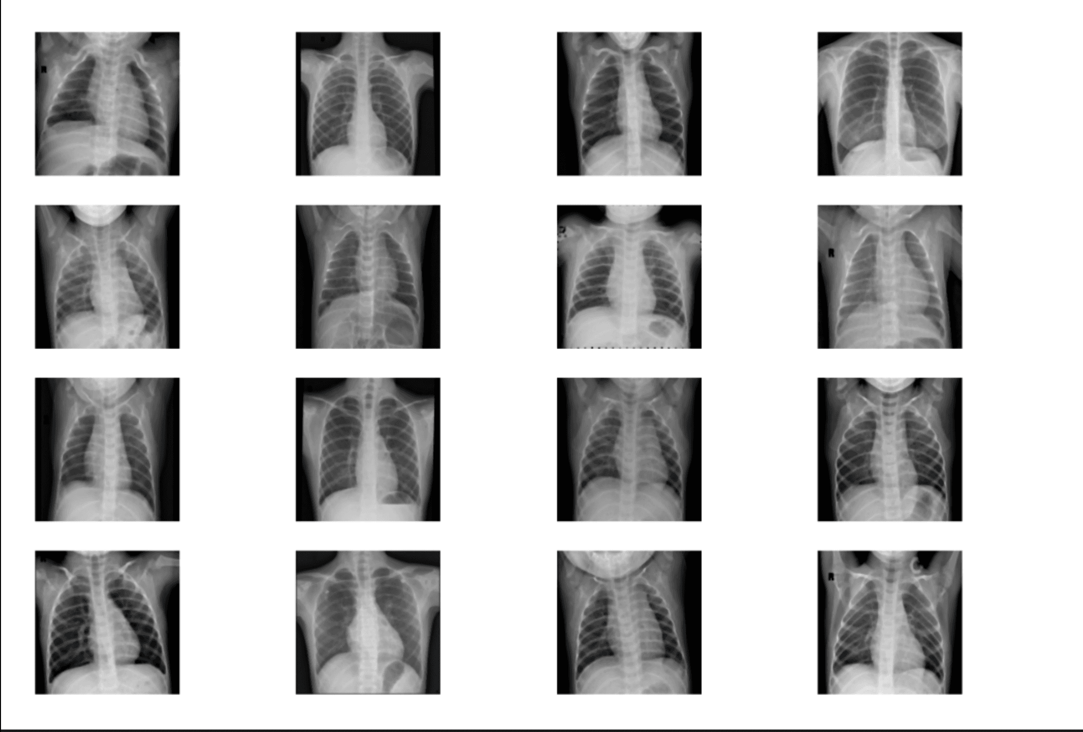 Pneumonia X-Ray Classification